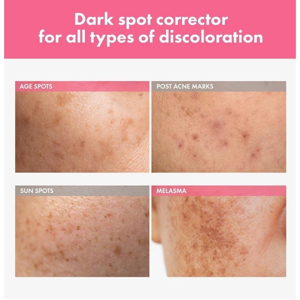 Arbutin 7% Intensive Spot Cream 70, 000ppm Arbutin, 3% Tranexamic Acid - Picture 2 of 5